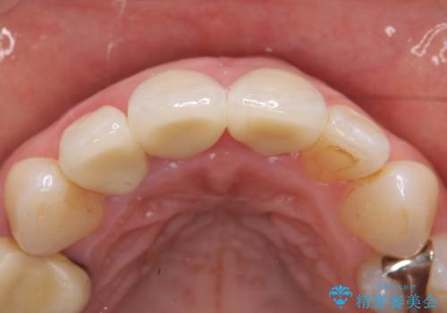 オールセラミッククラウン(スペシャル) 不揃いな前歯を美しくの治療後