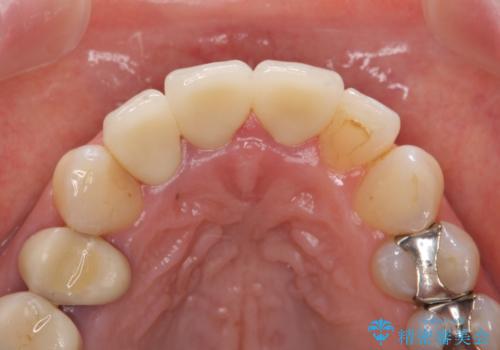 オールセラミッククラウン(スペシャル) 不揃いな前歯を美しくの治療後