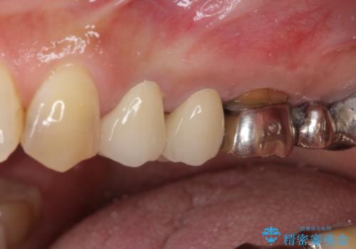 歯肉の縁に金属が見えて気になる　オールセラミッククラウンによる審美歯科治療の症例 治療後