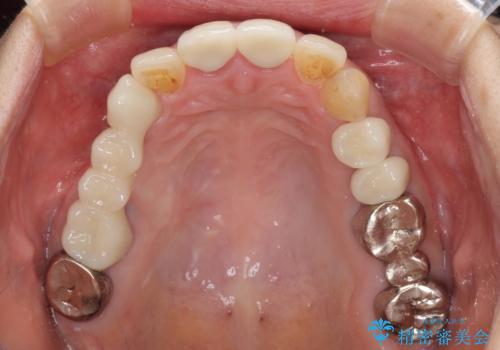 歯肉の縁に金属が見えて気になる　オールセラミッククラウンによる審美歯科治療の治療後