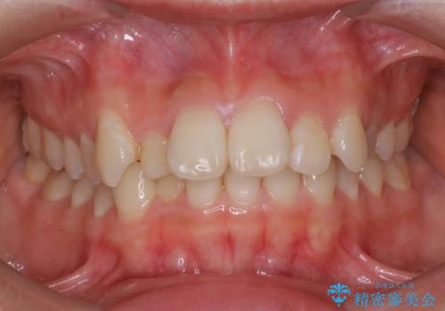 ハーフリンガル矯正 抜歯をして前歯を下げるの治療前