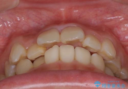 ハーフリンガル矯正 抜歯をして前歯を下げるの治療前