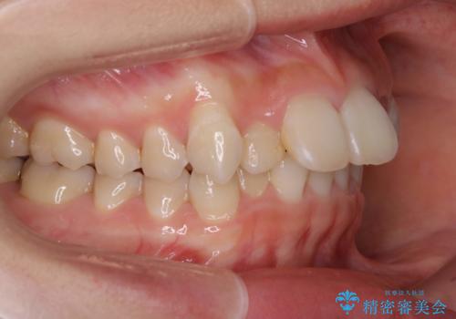 ハーフリンガル矯正　抜歯をして前歯を下げるの症例 治療前