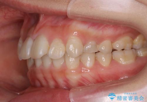 ハーフリンガル矯正 抜歯をして前歯を下げるの治療前