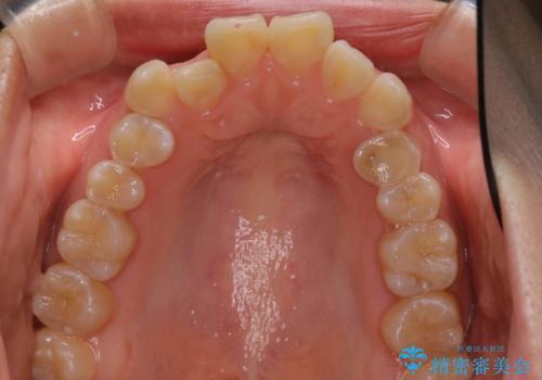 ハーフリンガル矯正 抜歯をして前歯を下げるの治療前