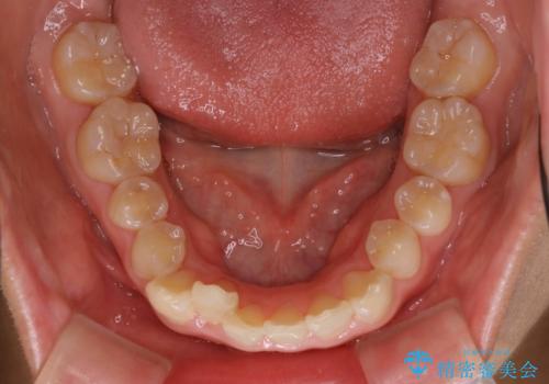 ハーフリンガル矯正 抜歯をして前歯を下げるの治療前