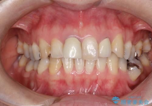 不自然な保険のかぶせ物をセラミックで自然な前歯への治療前