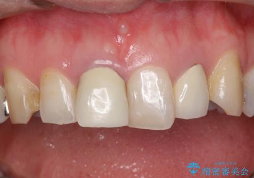 不自然な保険のかぶせ物をセラミックで自然な前歯への治療前