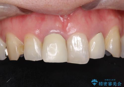 不自然な保険のかぶせ物をセラミックで自然な前歯への治療前