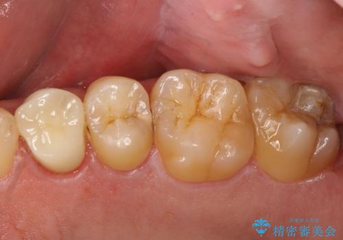 大きな虫歯で崩壊した歯の修復の症例 治療後