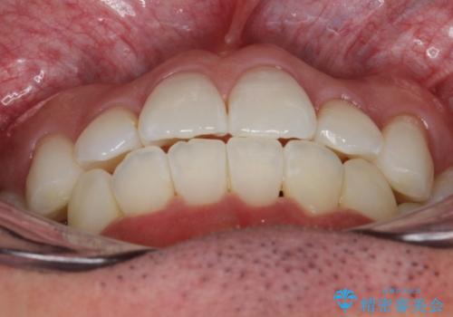 フルリンガル矯正 非抜歯でガタつきを整えるの治療後