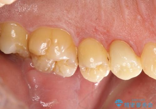 大きな虫歯で崩壊した歯の修復の治療後