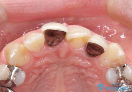 不自然な保険のかぶせ物をセラミックで自然な前歯への治療前