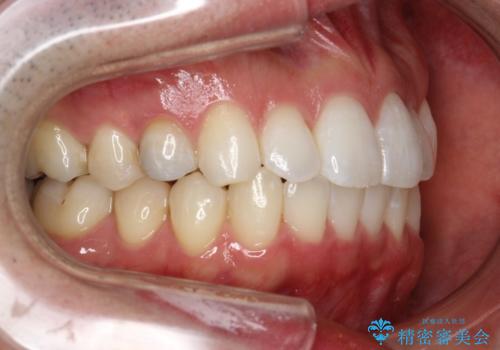 フルリンガル矯正 非抜歯でガタつきを整えるの治療後