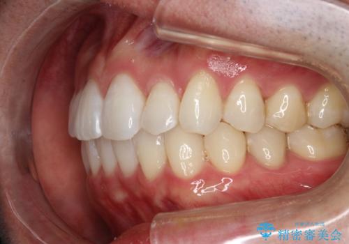 フルリンガル矯正 非抜歯でガタつきを整えるの治療後