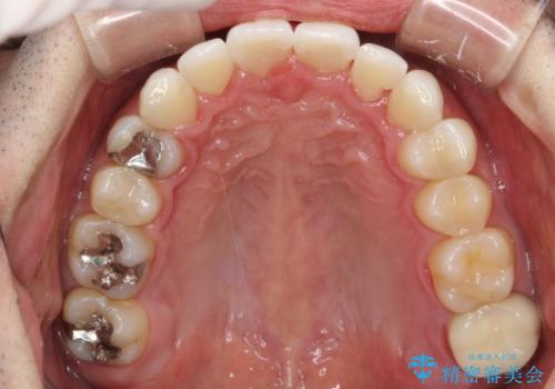フルリンガル矯正 非抜歯でガタつきを整えるの治療後