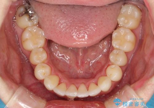フルリンガル矯正　非抜歯でガタつきを整えるの治療後