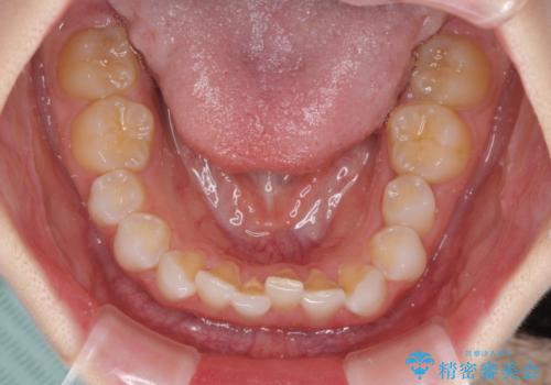 デコボコと深い咬み合わせの改善　インビザラインによる矯正治療の治療前