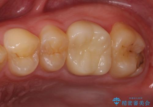 根管治療中の転院　奥歯のオールセラミック治療の症例 治療後