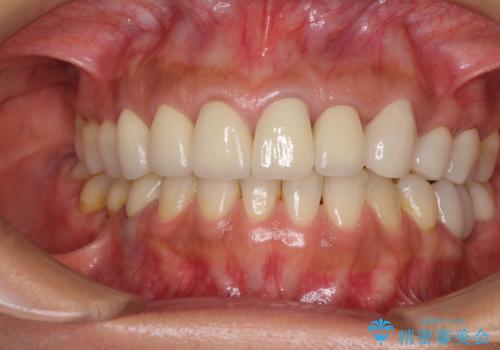 歯肉の高さをそろえたい 前歯の審美歯科治療の治療後