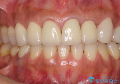 歯肉の高さをそろえたい 前歯の審美歯科治療の治療後