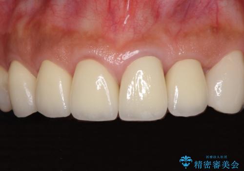 歯肉の高さをそろえたい 前歯の審美歯科治療の症例 治療後