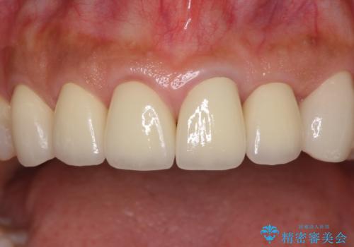 歯肉の高さをそろえたい 前歯の審美歯科治療の治療後