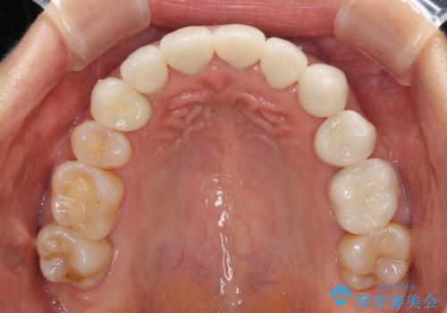 歯肉の高さをそろえたい 前歯の審美歯科治療の治療後