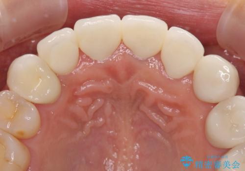 歯肉の高さをそろえたい 前歯の審美歯科治療の治療後