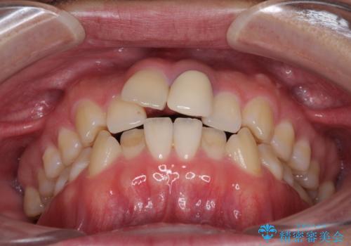 前歯の歯並びとクラウンを改善 インビザラインとオールセラミックの治療前