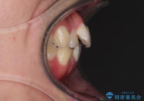 前歯の歯並びとクラウンを改善 インビザラインとオールセラミックの治療前