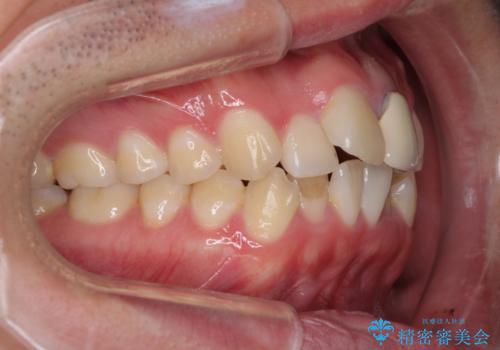 前歯の歯並びとクラウンを改善 インビザラインとオールセラミックの治療前