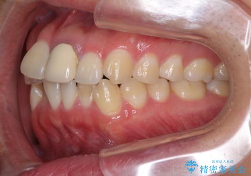 前歯の歯並びとクラウンを改善　インビザラインとオールセラミックの治療前