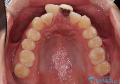 前歯の歯並びとクラウンを改善　インビザラインとオールセラミックの治療前