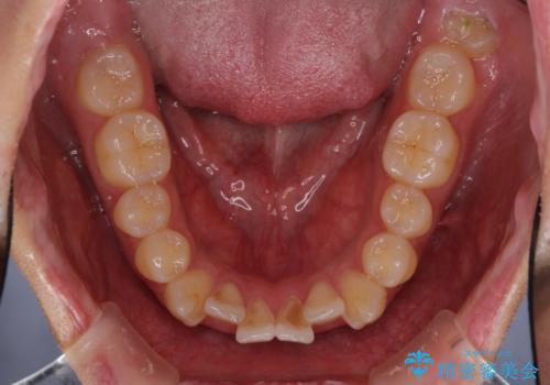 前歯の歯並びとクラウンを改善 インビザラインとオールセラミックの治療前