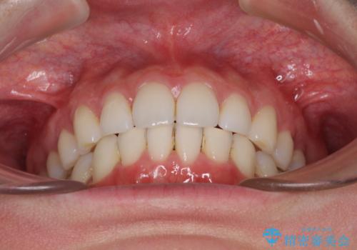 矯正治療の後戻りをインビザライン・ライトで改善の治療後