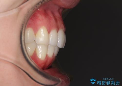 矯正治療の後戻りをインビザライン・ライトで改善の治療後