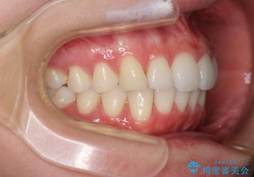 矯正治療の後戻りをインビザライン・ライトで改善の治療後
