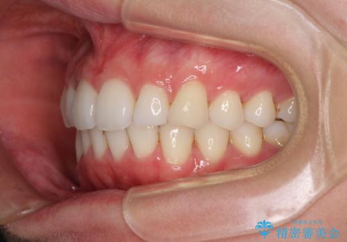 矯正治療の後戻りをインビザライン・ライトで改善の治療後