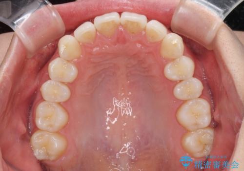 矯正治療の後戻りをインビザライン・ライトで改善の治療後