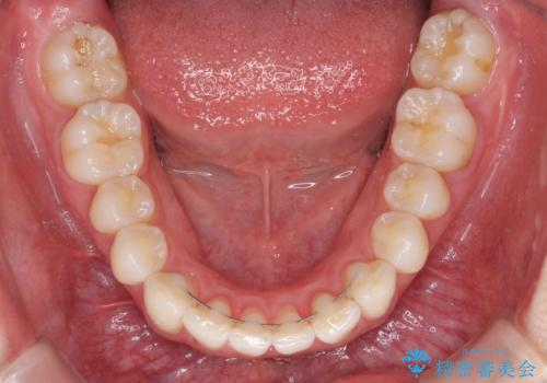 矯正治療の後戻りをインビザライン・ライトで改善の治療後