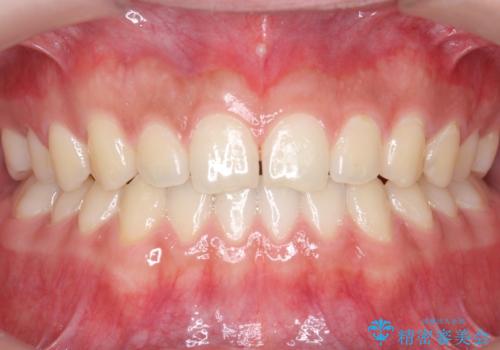前歯のすきま 受け口 インビザラインでの治療中