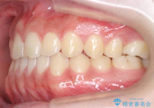 前歯のすきま 受け口 インビザラインでの治療中