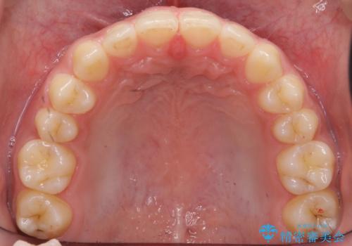 前歯のすきま 受け口 インビザラインでの治療中