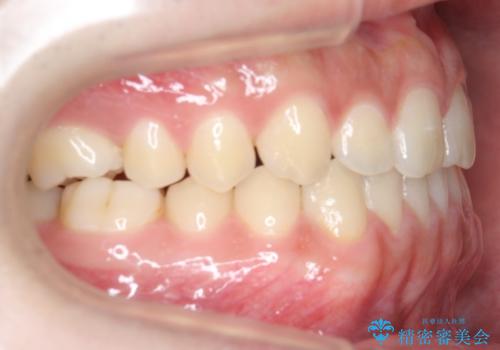 前歯のすきま 受け口 インビザラインでの治療中