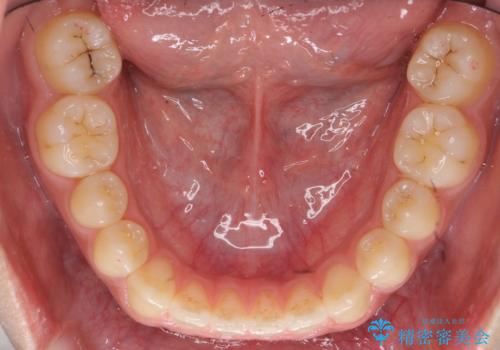 前歯のすきま 受け口 インビザラインでの治療中