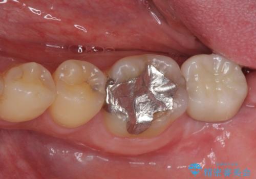 割れてしまった奥歯 インプラントによる咬合回復の症例 治療後