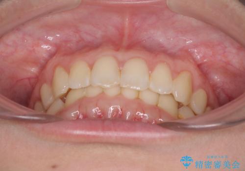 インビザラインによる前歯の矯正治療の治療後