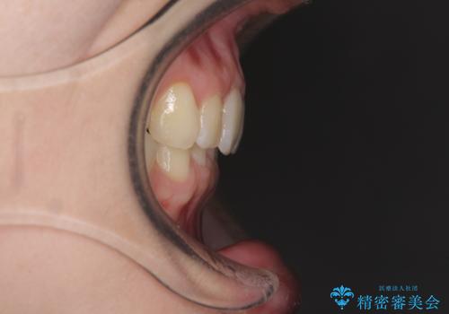 インビザラインによる前歯の矯正治療の治療後