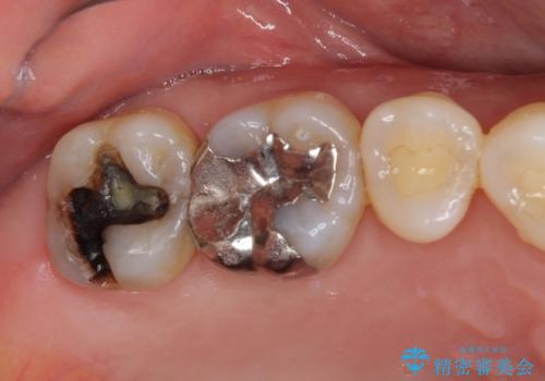 外れてしまった奥歯の銀歯 ゴールドインレーによる修復治療の症例 治療前